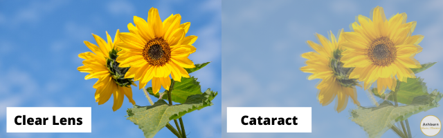 bright clear sunflower on left labeled clear lens, dull blurry sunflower on right labeled cataract
